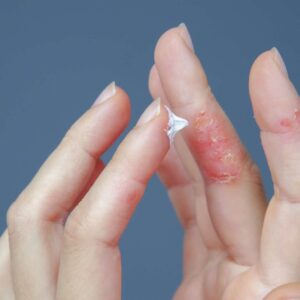 Eczema Self-Care Methods