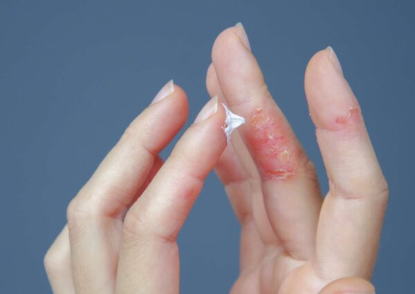 Eczema Self-Care Methods